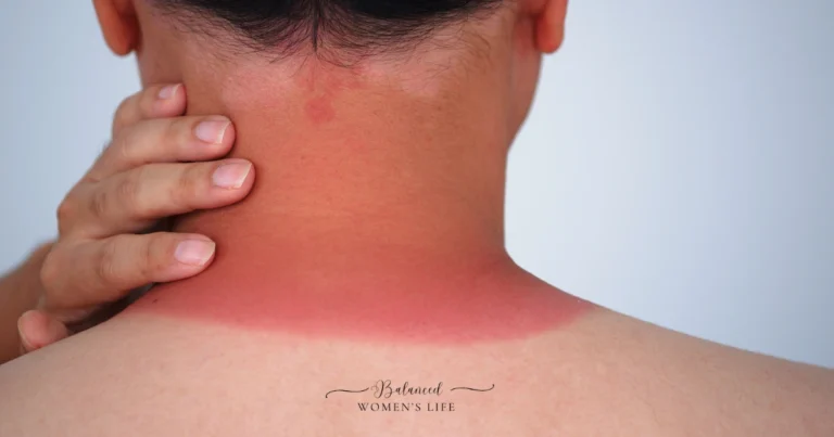Discover everything you need to know about sun poisoning: causes, symptoms, treatment options, prevention tips, and when to seek medical help.