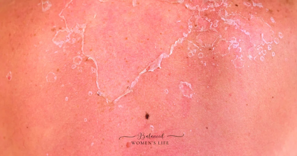 sun poisoning